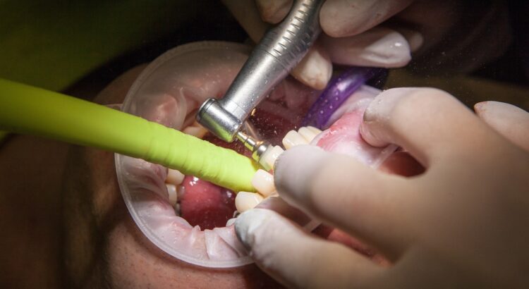 De ce să alegi tratamentul cu implanturi dentare