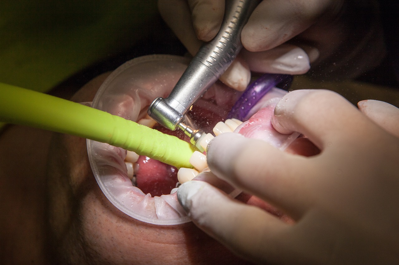 De ce să alegi tratamentul cu implanturi dentare: motive și beneficii